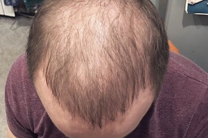 Как начинают расти волосы после алопеции – как отрастить